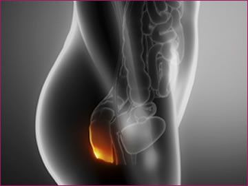 Absceso anal | Dr. Xavier Obando | Coloproctólgo Quito