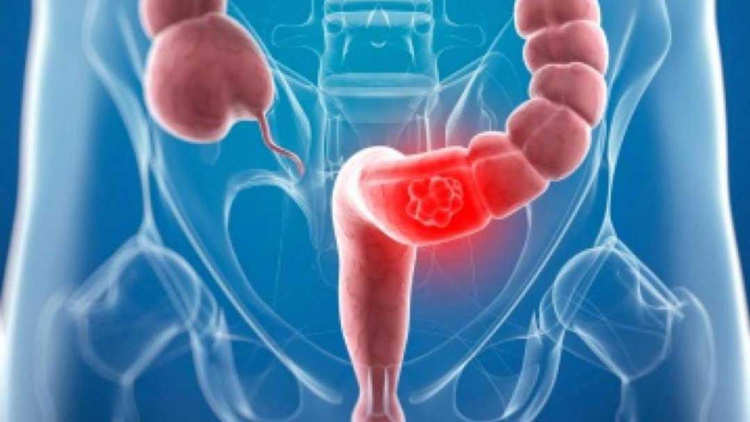 Cáncer Colon | Dr. Xavier Obando | Coloproctólogo Quito